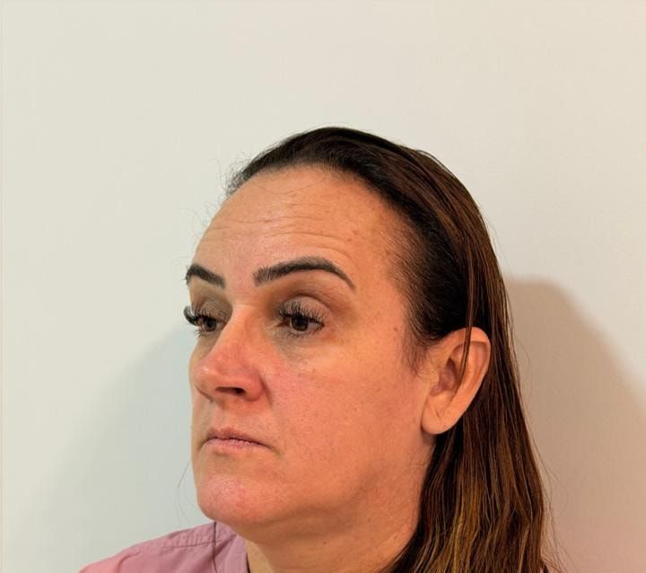 Antes: rosto de três quartos de uma paciente